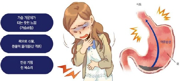 역류성 식도염으로 아파하는 여자
