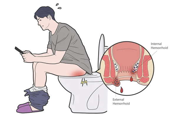 치질 사진