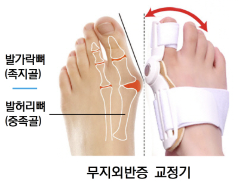 무지외반증 교정기 사진
