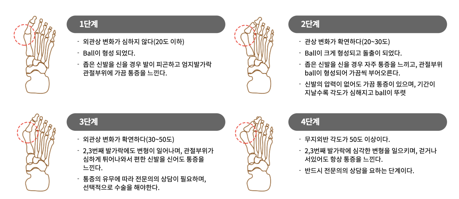 무지외반증 단계별 사진