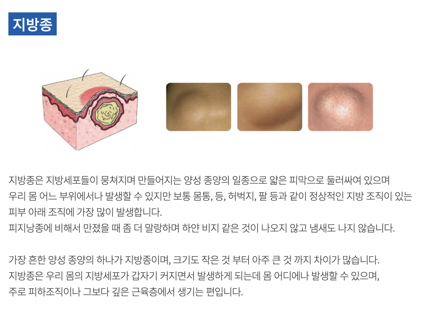 지방종 사진