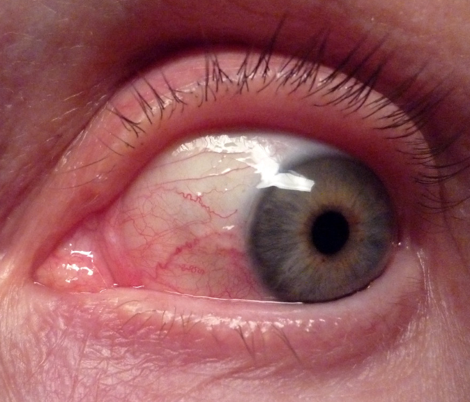 결막염 사진