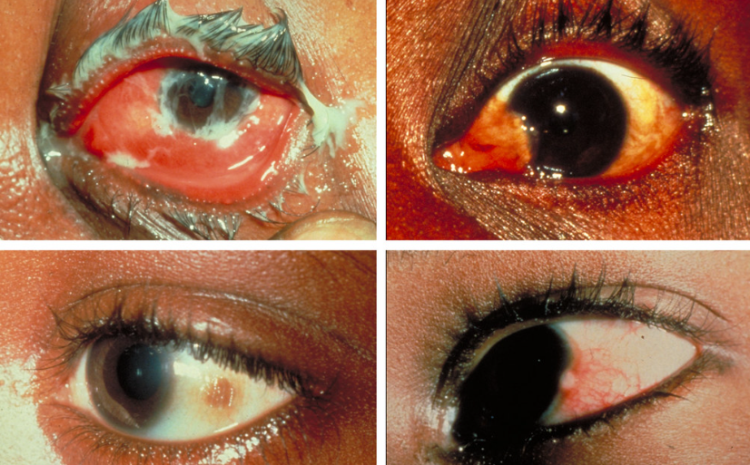 결막염 사진