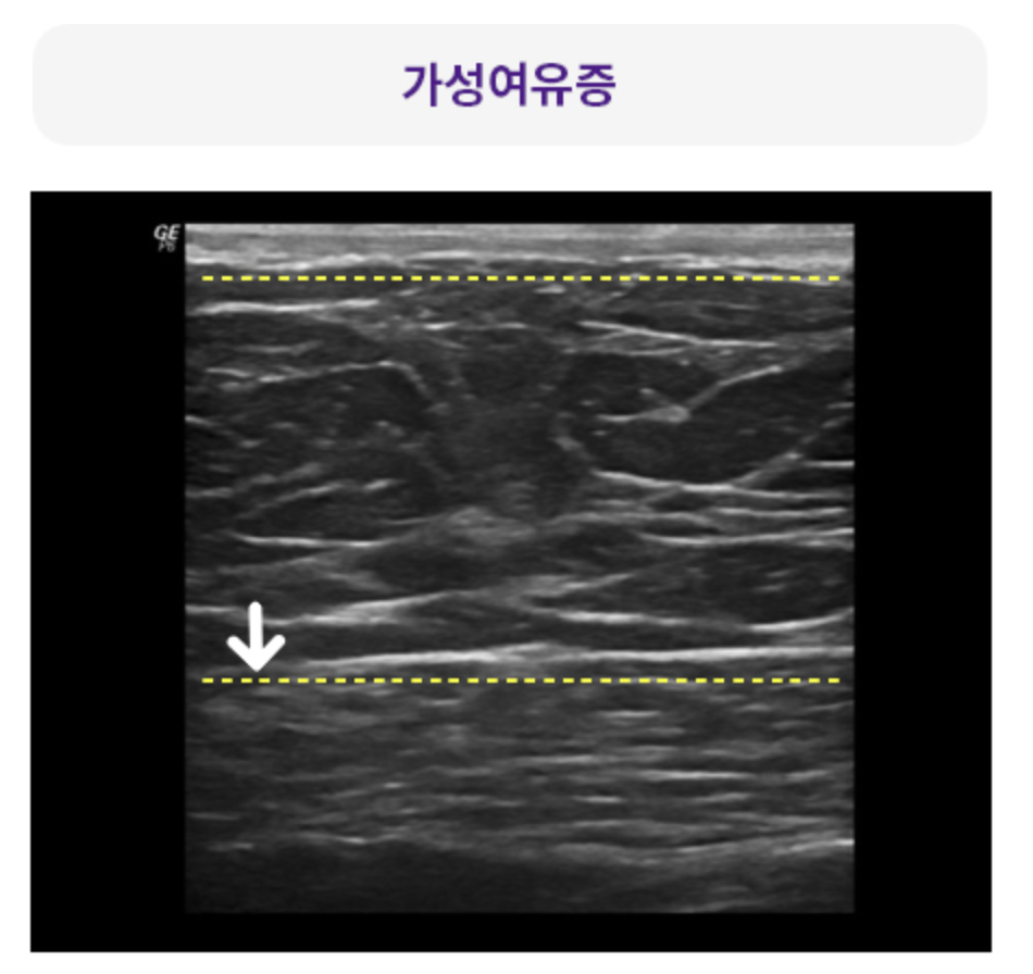 가성여유증 사진