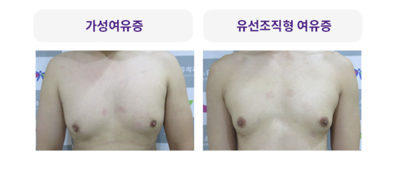 여유증 비교사진