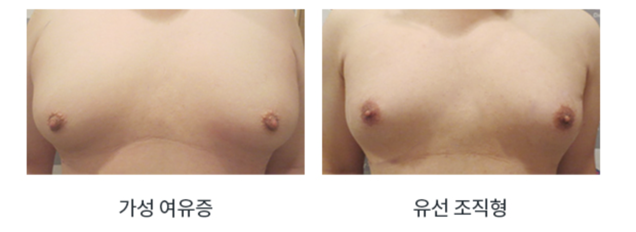 여유증