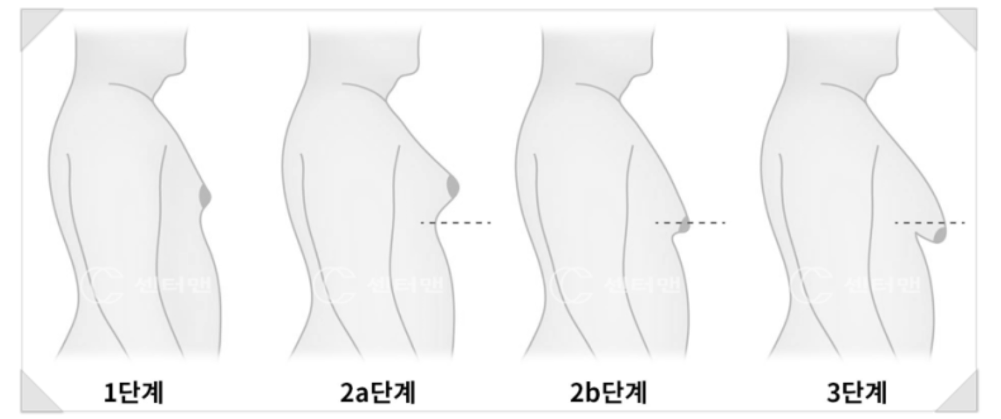 여유증 단계