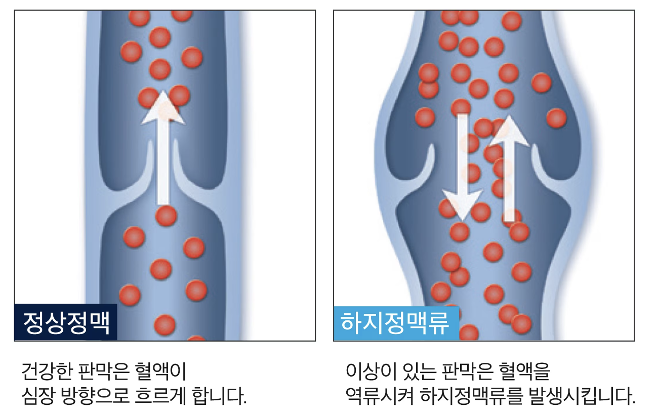 하지 정맥류 사진
