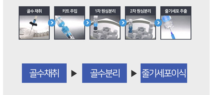 줄기세포 치료 방법