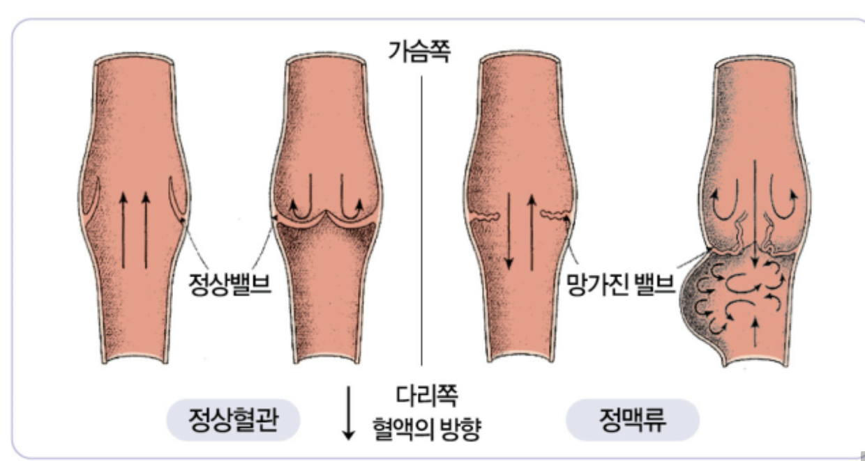하지 정맥류 사진