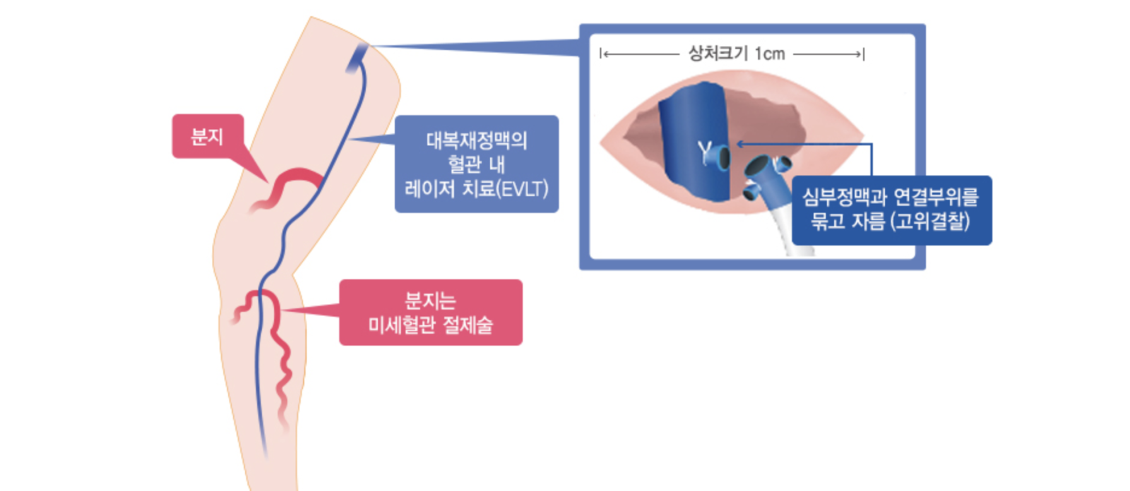 하지 정맥류 수술