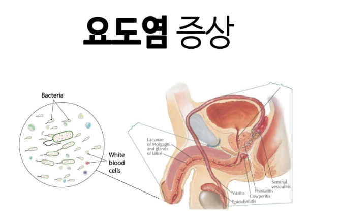 요도염 증상