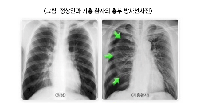 기흉 환자 x-레이 사진