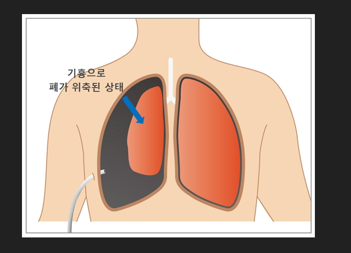 기흉 상태 사진