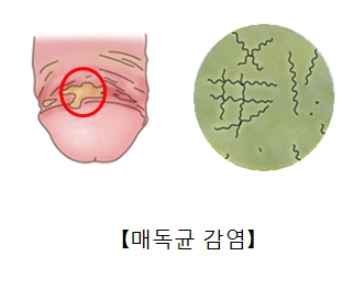매독균 감염 모습