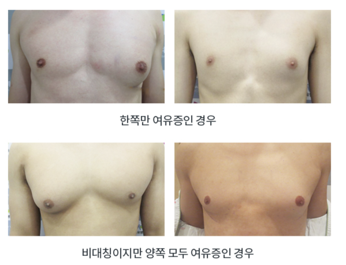 여유증