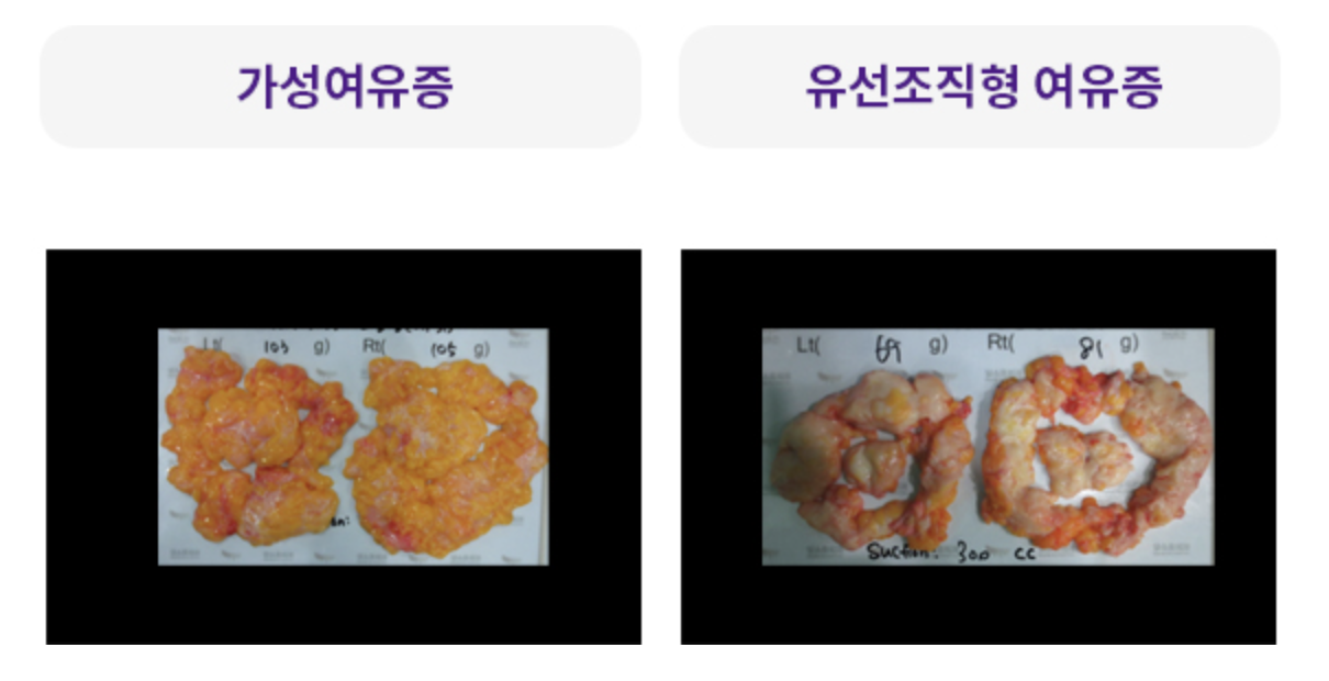 제거된 유선조직 비교