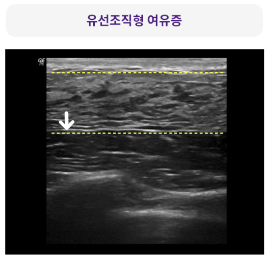 유선조직형 여유증