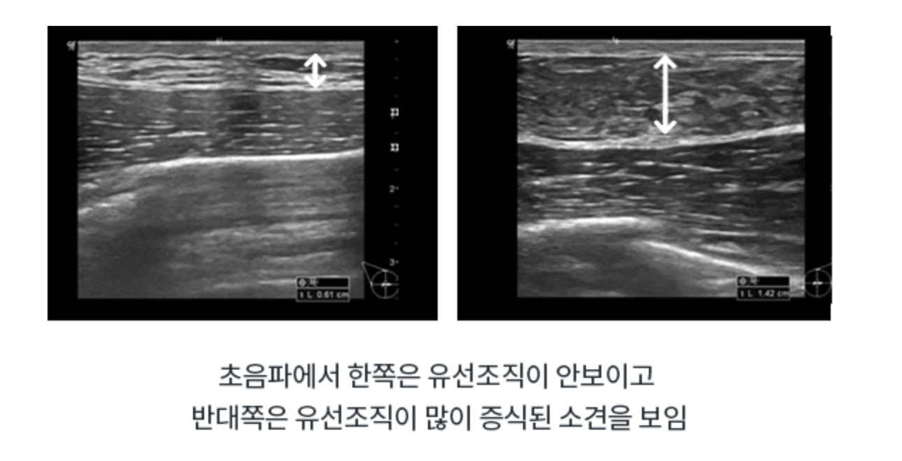 여유증 초음파 사진
