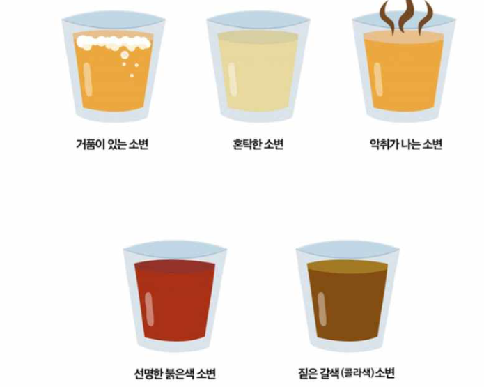 거품있는 소변, 혼탁한 소변, 악취가 나는 소변, 선명한 붉은색 소변, 짙은갈색(콜라색)소변의 그림 사진