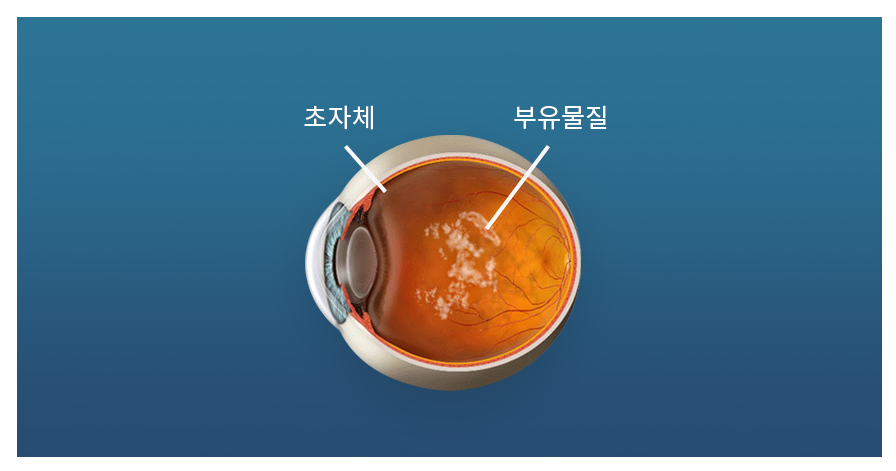 비문증 증상 사진