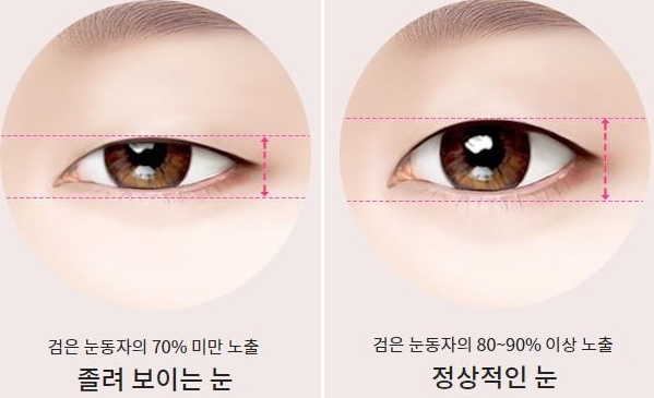 안검하수 눈과 정상 눈 비교