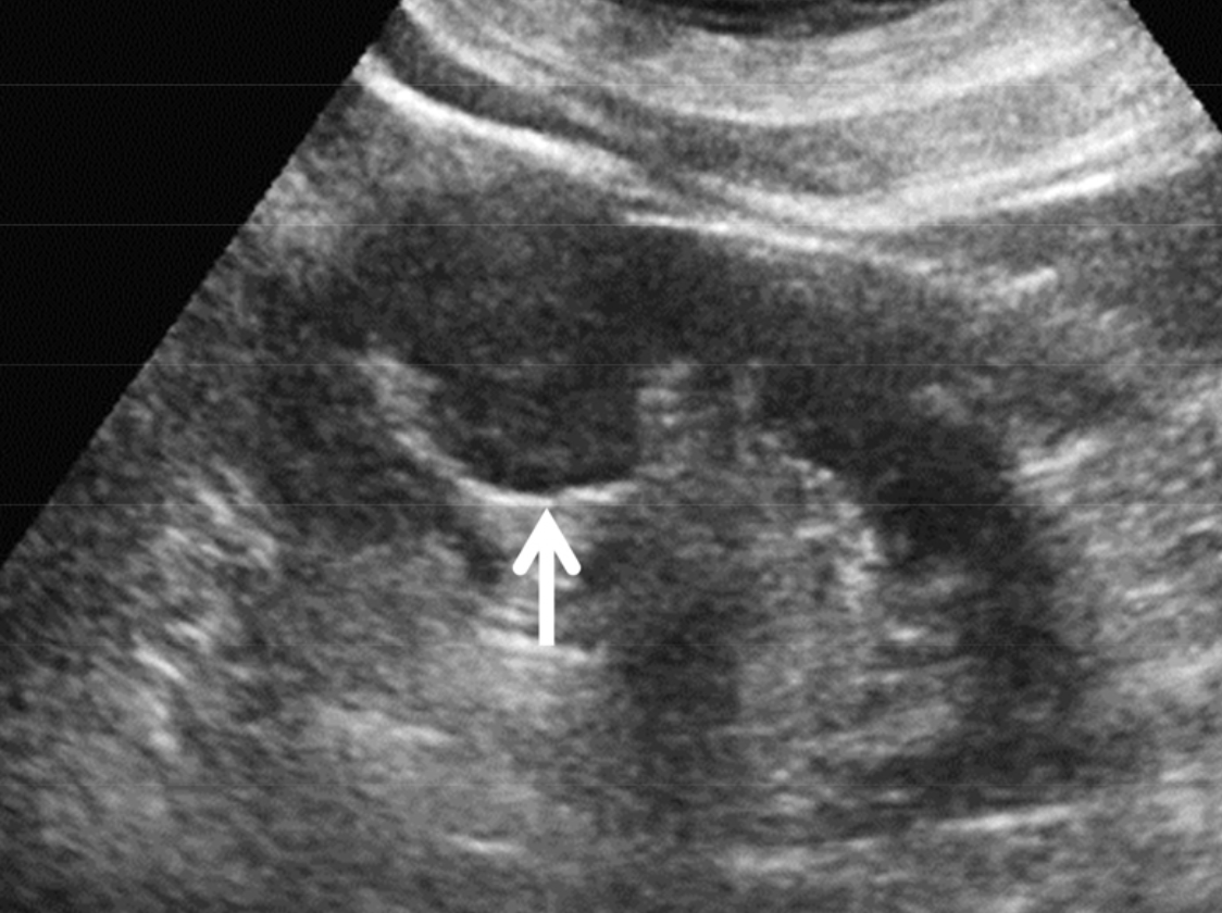 신장 초음파 검사