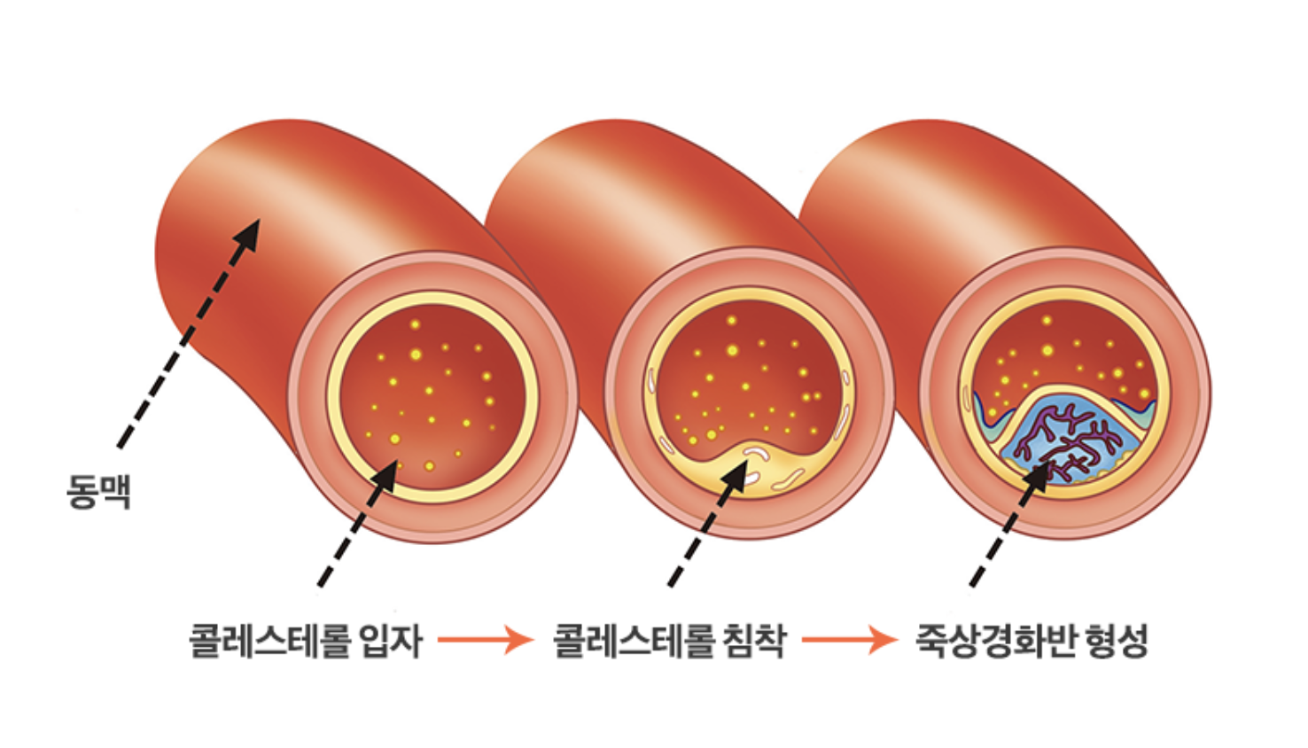 고지혈증 치료 사진