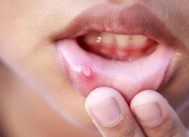 칸디다증에 걸린 입술에 포진이 올라온 사진.