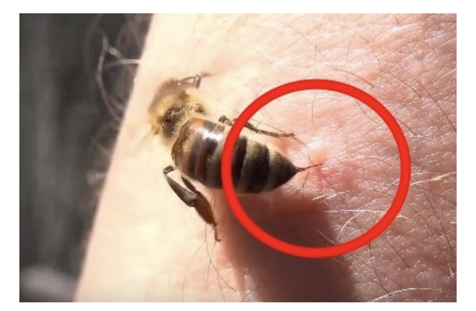 벌독 알레르기 증상 검사
