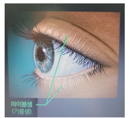 마이봄샘 기능 이상