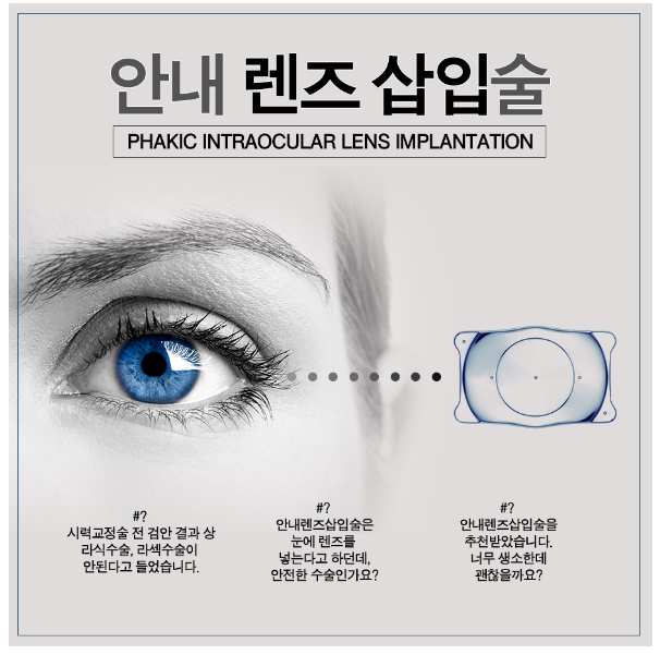 안내렌즈삽입술(ICL)