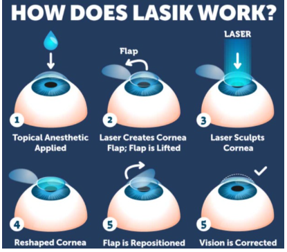 라식(LASIK)