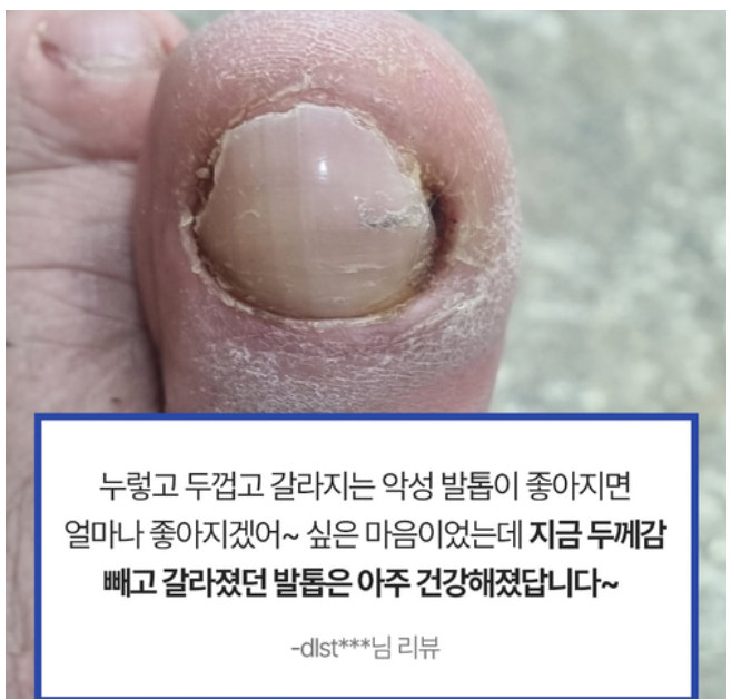 무좀약 라셀턴 사용법: 확실하게 한방에 없애기