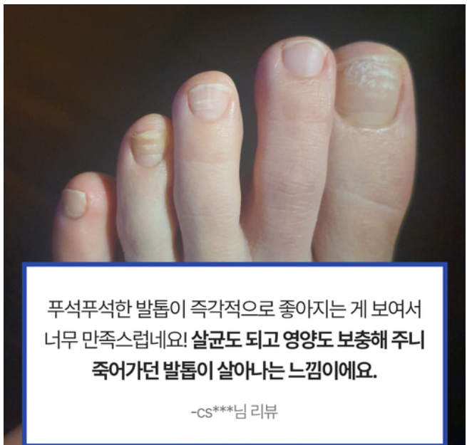 무좀약 라셀턴 사용법: 확실하게 한방에 없애기